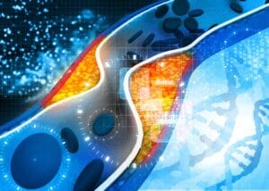 Conceptual illustration of cholesterol buildup in arteries alongside DNA — symbolizing the convergence of genetics and cardiovascular risk